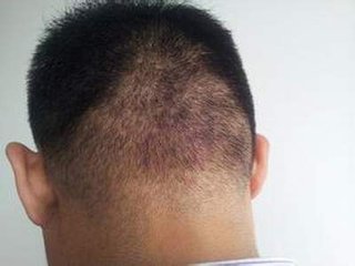 因此头部患有毛囊炎的患者在护理时要避免头皮的损伤,尤其是在洗头时